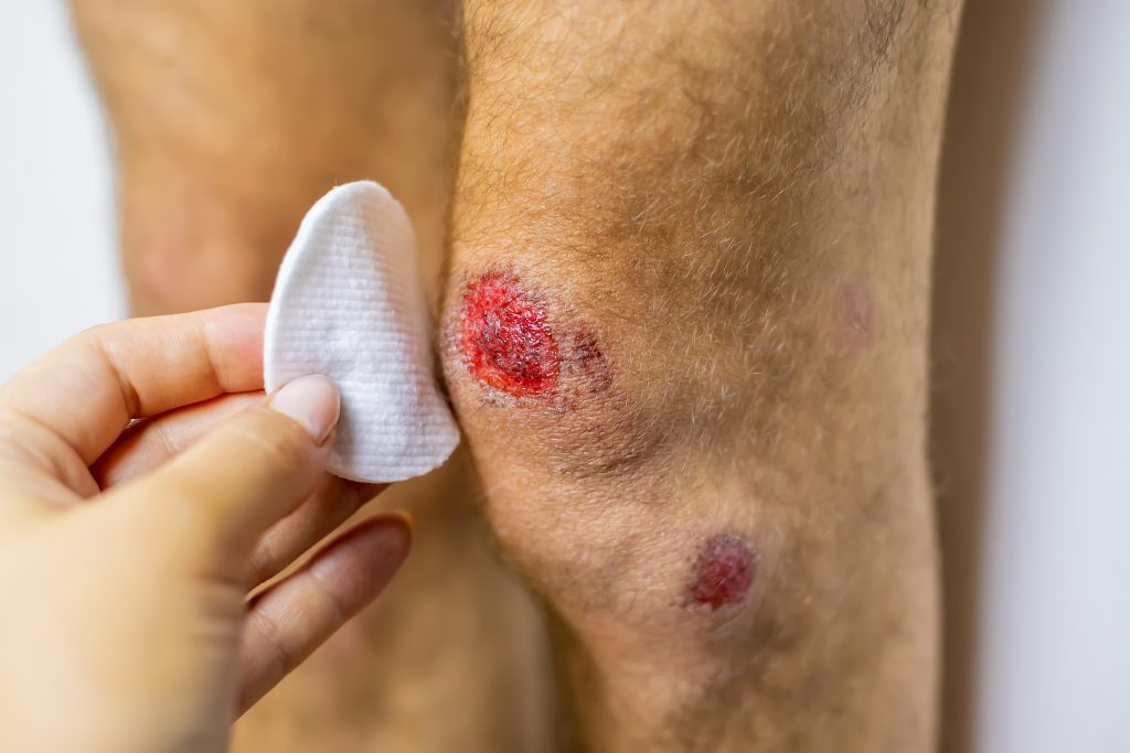 Debridement & Skin Grafts