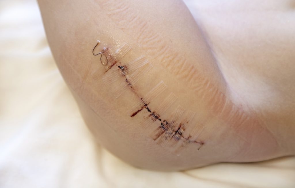 Surgical & Traumatic Wounds Treated in Highlands Ranch